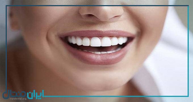5 روش جلوگیری از زرد شدن کامپوزیت دندان