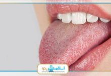 7 درمان خانگی خشکی دهان چیست؟