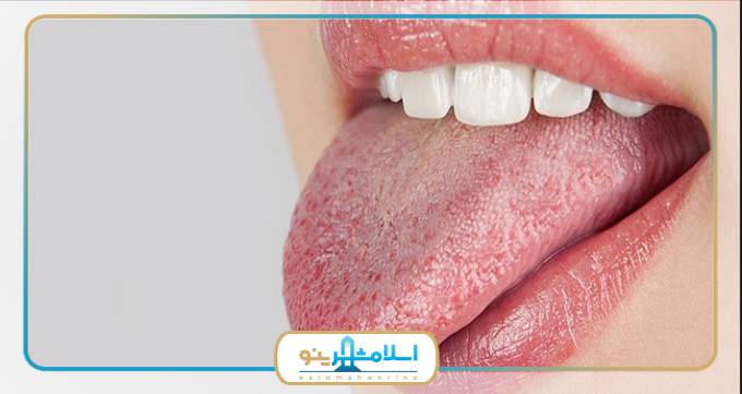 7 درمان خانگی خشکی دهان چیست؟